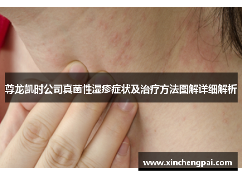 尊龙凯时公司真菌性湿疹症状及治疗方法图解详细解析